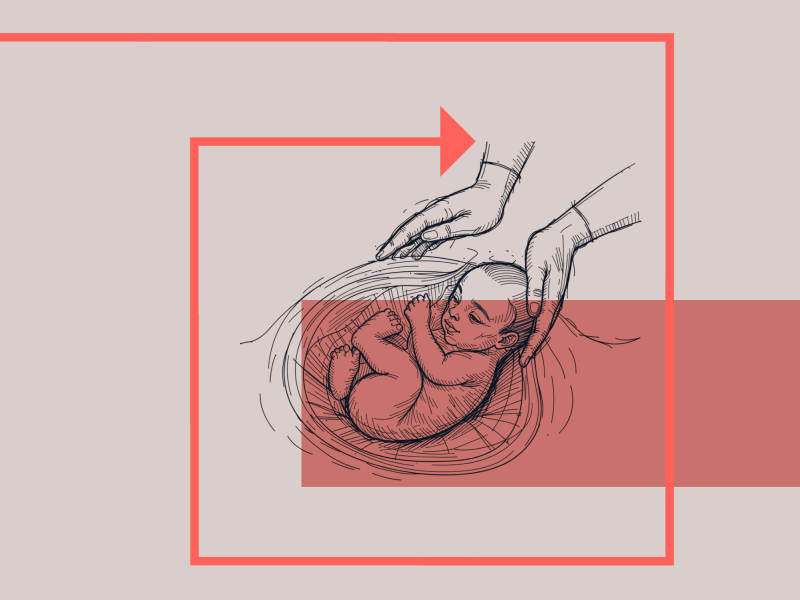 Kejsersnit: Tegning af baby der bliver løftet ud af en mave